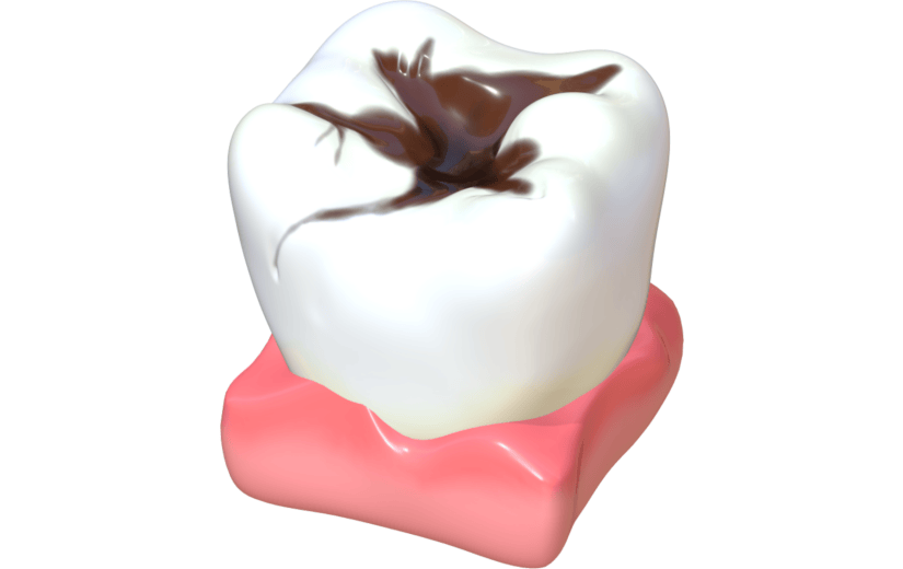 3D立体蛀牙牙模